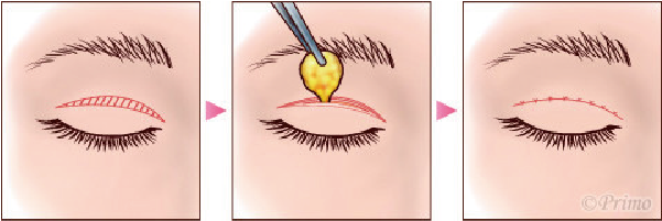 埋没法イラスト